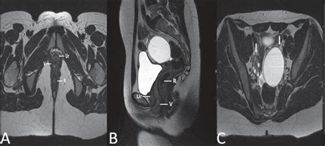 camera inside vag|Magnetic resonance imaging of male and female genitals during .